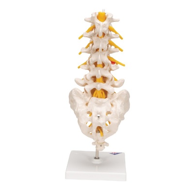 3B Scientific Lumbar Spine Model with Dorso-Lateral Prolapsed Intervertebral Disc
